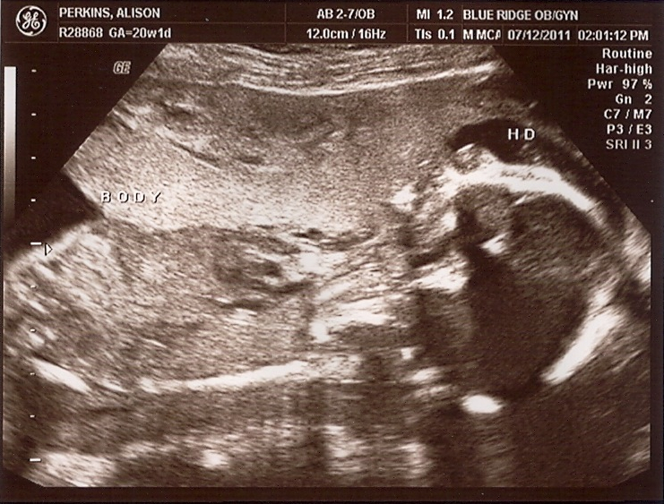 20-week Ultrasound