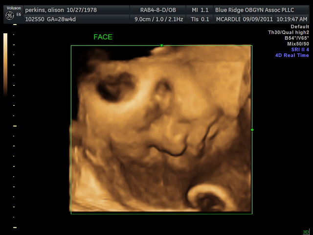 3D Ultrasound!