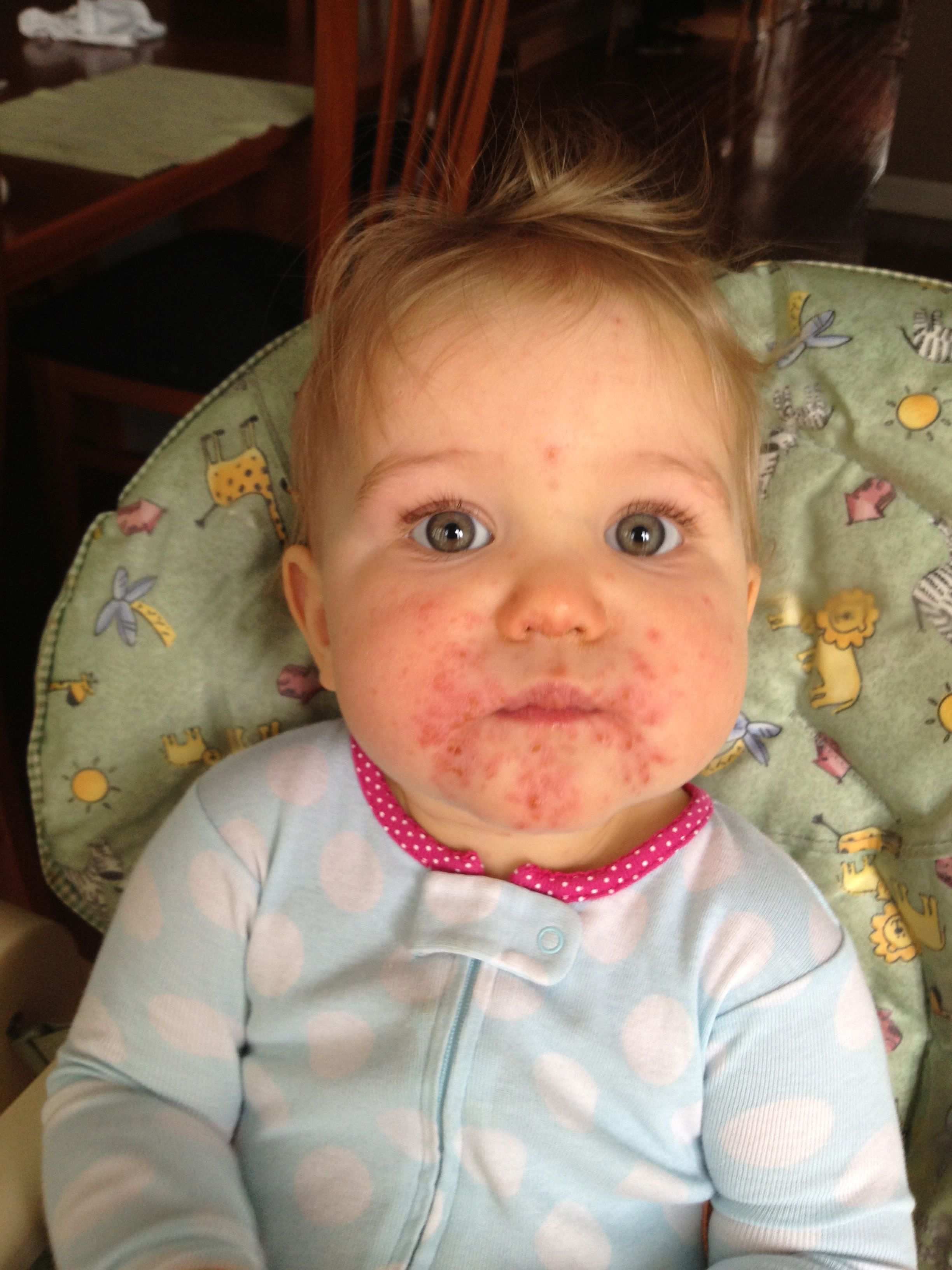 Kendall’s Horrible HFMD